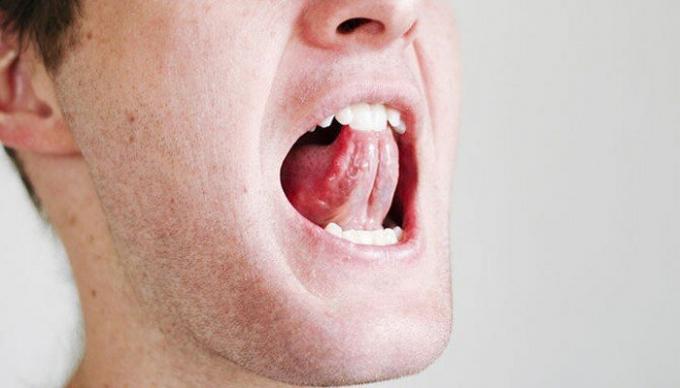 Quelques exercices simples pour la gorge et la langue peuvent soulager la situation avec le ronflement. / Photo: i2.wp.com. 